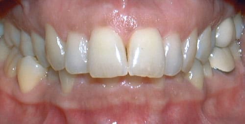 Overbite Problem CoastSide Family Orthodontics in Naples, FL